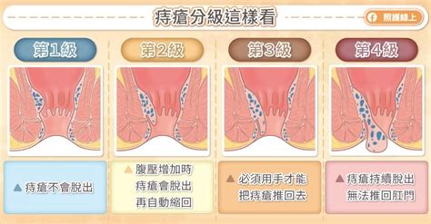 為什麼會長痔|痔瘡會自己好嗎？醫師說明痔瘡原因、有哪些症狀與如。